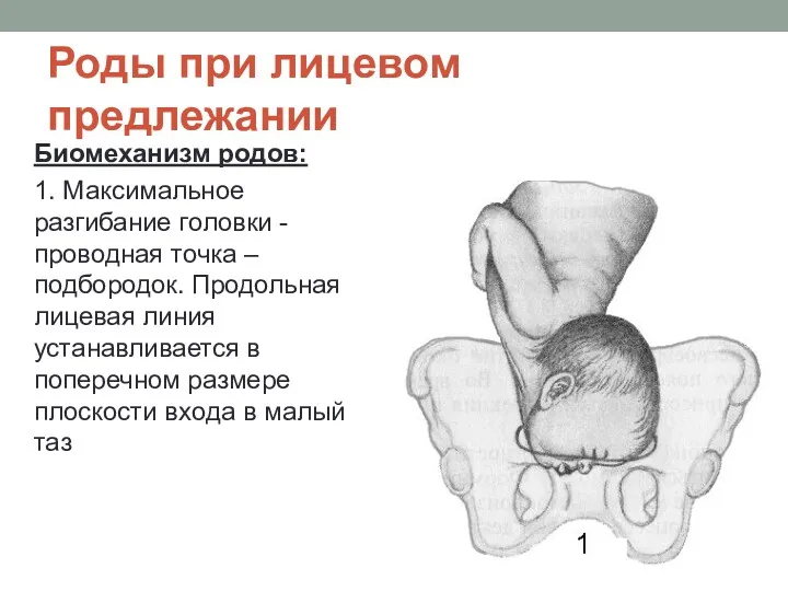 Роды при лицевом предлежании Биомеханизм родов: 1. Максимальное разгибание головки