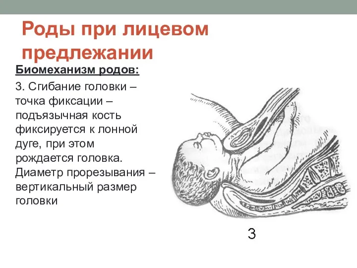 Роды при лицевом предлежании Биомеханизм родов: 3. Сгибание головки –