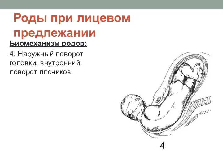 Роды при лицевом предлежании Биомеханизм родов: 4. Наружный поворот головки, внутренний поворот плечиков.