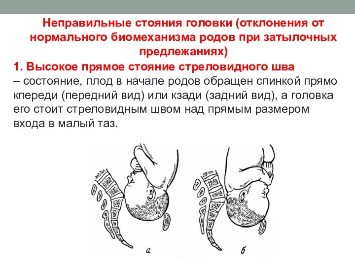 Неправильные стояния головки (отклонения от нормального биомеханизма родов при затылочных