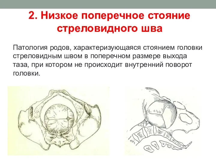 2. Низкое поперечное стояние стреловидного шва Патология родов, характеризующаяся стоянием