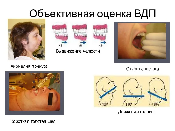 Объективная оценка ВДП Аномалия прикуса Выдвижение челюсти Открывание рта Движения головы Короткая толстая шея