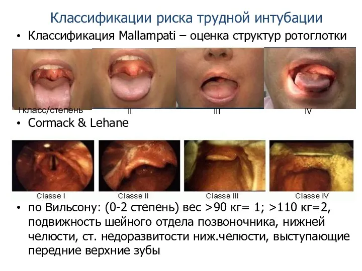 Классификации риска трудной интубации Классификация Mallampati – оценка структур ротоглотки