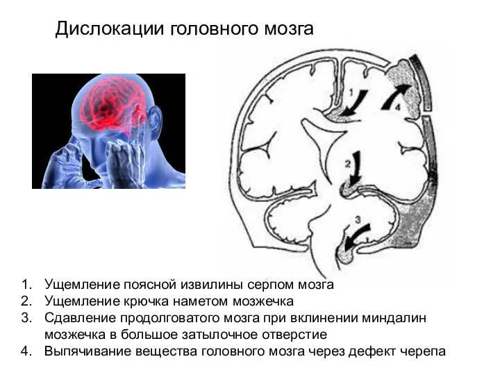 Дислокации головного мозга Ущемление поясной извилины серпом мозга Ущемление крючка