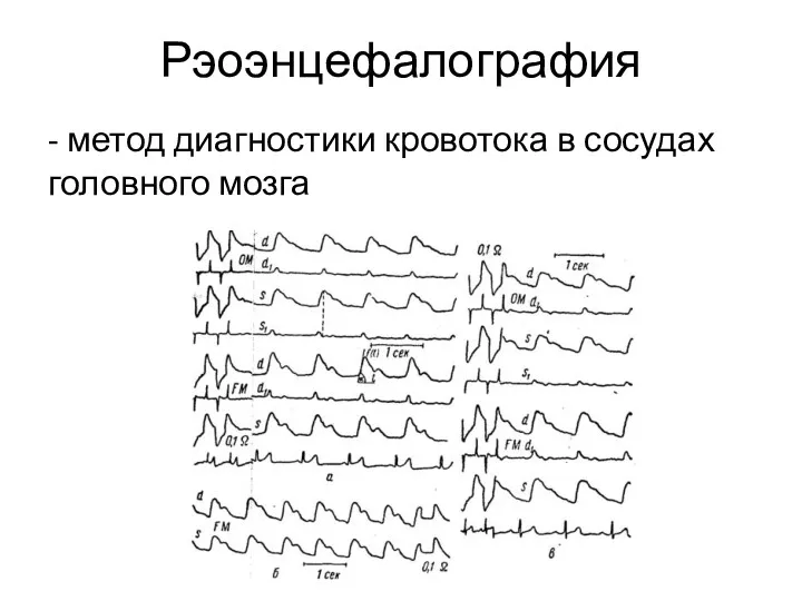 Рэоэнцефалография - метод диагностики кровотока в сосудах головного мозга