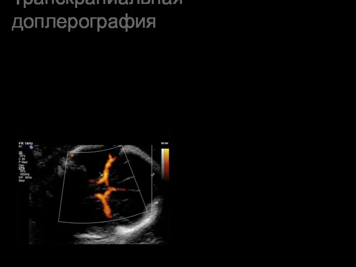 Транскраниальная доплерография - метод ультразвукового сканирования, позволяющий оценить скорость, давление