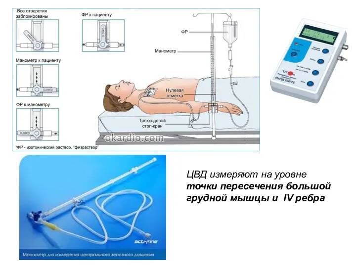 ЦВД измеряют на уровне точки пересечения большой грудной мышцы и IV ребра