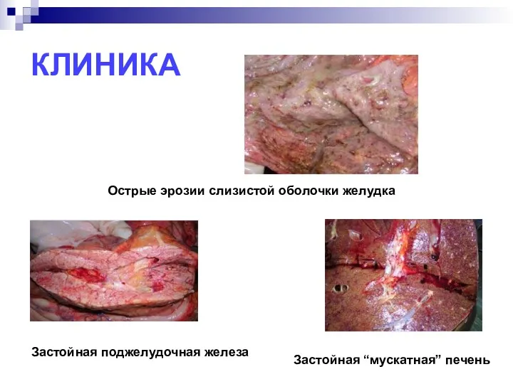 КЛИНИКА Острые эрозии слизистой оболочки желудка Застойная “мускатная” печень Застойная поджелудочная железа