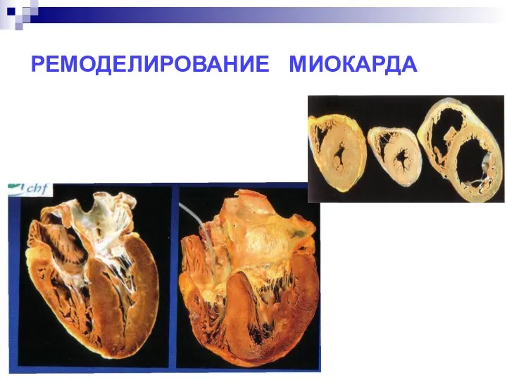 РЕМОДЕЛИРОВАНИЕ МИОКАРДА