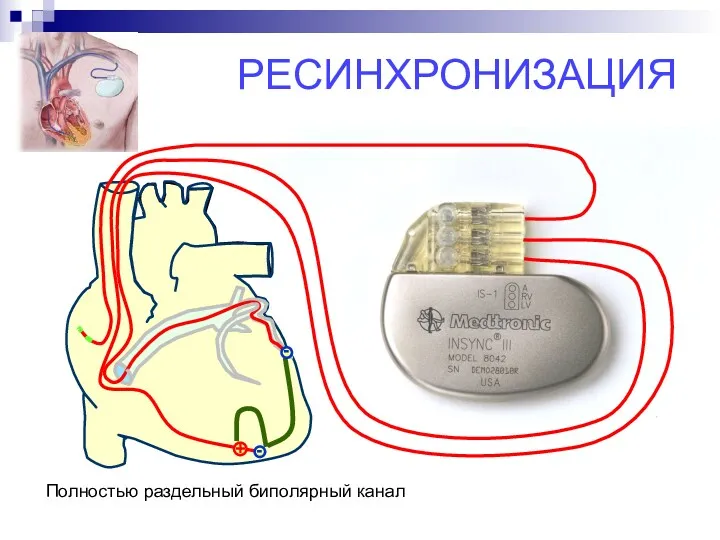 РЕСИНХРОНИЗАЦИЯ Полностью раздельный биполярный канал