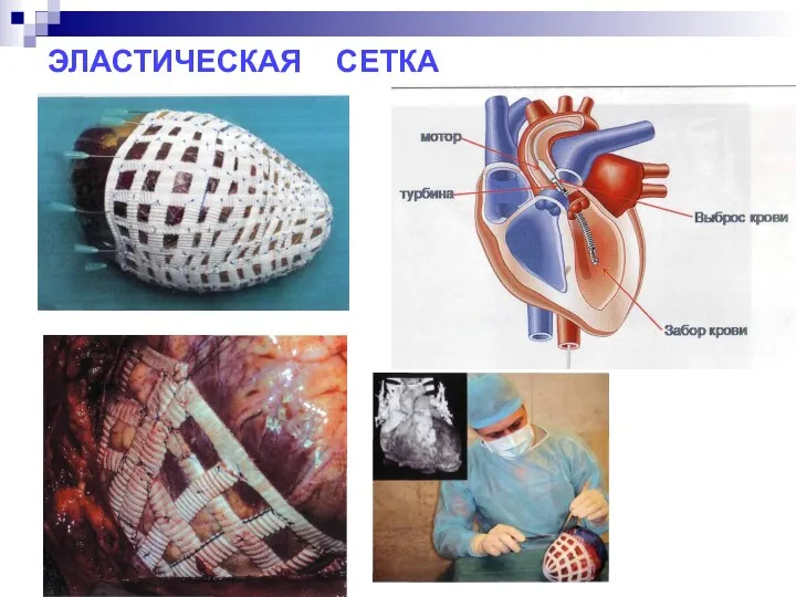 ЭЛАСТИЧЕСКАЯ СЕТКА