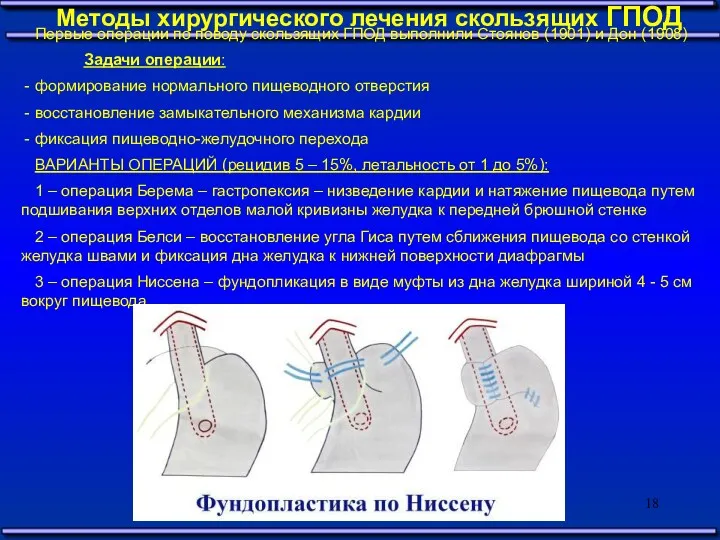 Методы хирургического лечения скользящих ГПОД Первые операции по поводу скользящих ГПОД выполнили Стоянов
