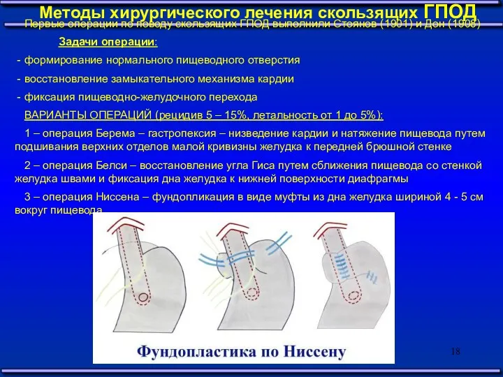 Методы хирургического лечения скользящих ГПОД Первые операции по поводу скользящих