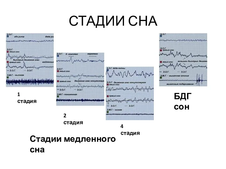 СТАДИИ СНА 1 стадия 2 стадия БДГ сон 4 стадия Стадии медленного сна