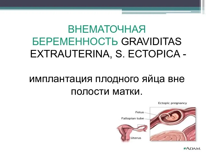 ВНЕМАТОЧНАЯ БЕРЕМЕННОСТЬ GRAVIDITAS EXTRAUTERINA, S. ECTOPICA - имплантация плодного яйца вне полости матки.