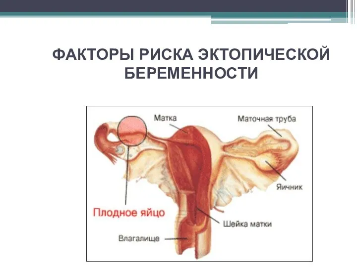 ФАКТОРЫ РИСКА ЭКТОПИЧЕСКОЙ БЕРЕМЕННОСТИ