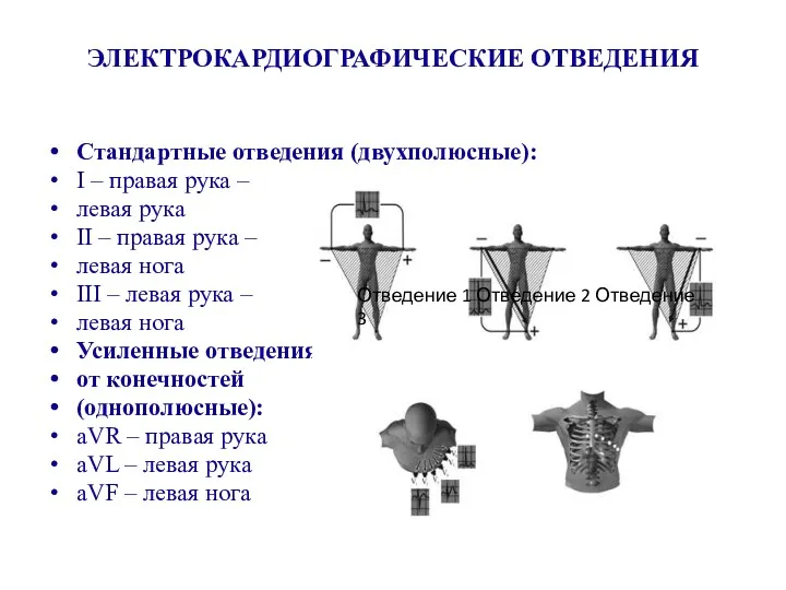 ЭЛЕКТРОКАРДИОГРАФИЧЕСКИЕ ОТВЕДЕНИЯ Стандартные отведения (двухполюсные): I – правая рука –