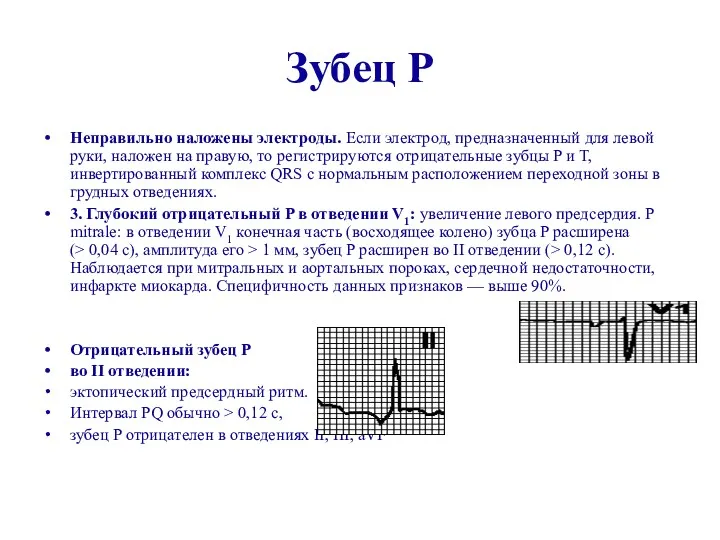 Зубец Р Неправильно наложены электроды. Если электрод, предназначенный для левой