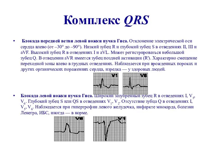 Комплекс QRS Блокада передней ветви левой ножки пучка Гиса. Отклонение