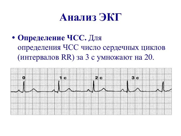Анализ ЭКГ Определение ЧСС. Для определения ЧСС число сердечных циклов