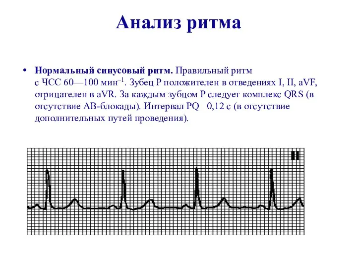 Анализ ритма Нормальный синусовый ритм. Правильный ритм с ЧСС 60—100