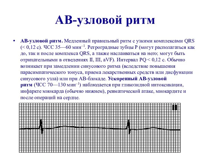 АВ-узловой ритм АВ-узловой ритм. Медленный правильный ритм с узкими комплексами QRS (