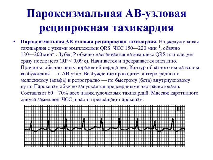 Пароксизмальная АВ-узловая реципрокная тахикардия Пароксизмальная АВ-узловая реципрокная тахикардия. Наджелудочковая тахикардия