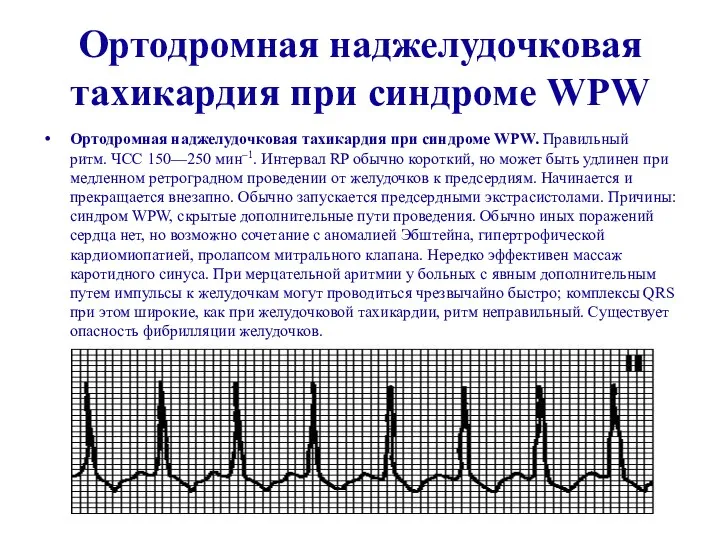 Ортодромная наджелудочковая тахикардия при синдроме WPW Ортодромная наджелудочковая тахикардия при