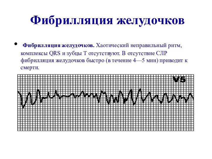 Фибрилляция желудочков Фибрилляция желудочков. Хаотический неправильный ритм, комплексы QRS и