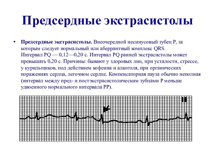 Предсердные экстрасистолы Предсердные экстрасистолы. Внеочередной несинусовый зубец P, за которым