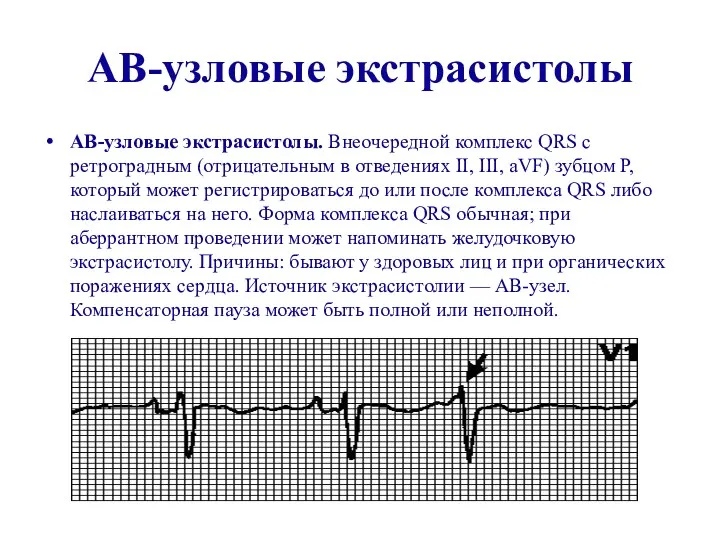 АВ-узловые экстрасистолы АВ-узловые экстрасистолы. Внеочередной комплекс QRS с ретроградным (отрицательным