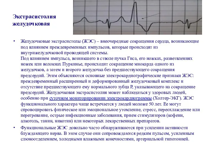 Экстрасистолия желудочковая Желудочковые экстрасистолы (ЖЭС) – внеочередные сокращения сердца, возникающие