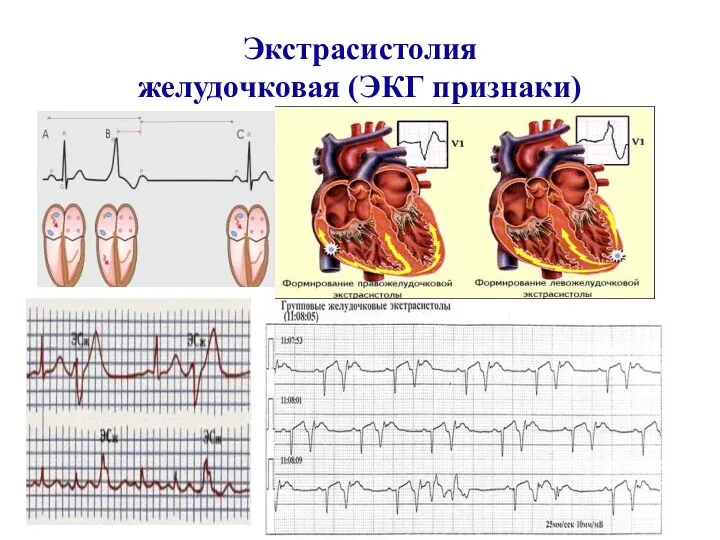 Экстрасистолия желудочковая (ЭКГ признаки)