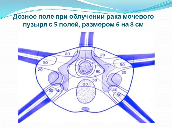 Дозное поле при облучении рака мочевого пузыря с 5 полей, размером 6 на 8 см