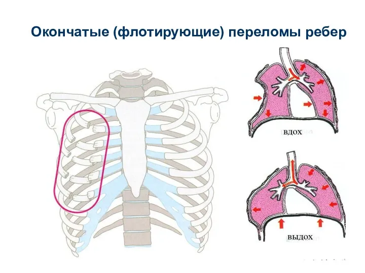 Окончатые (флотирующие) переломы ребер