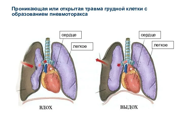 Проникающая или открытая травма грудной клетки с образованием пневмоторакса сердце легкое легкое сердце