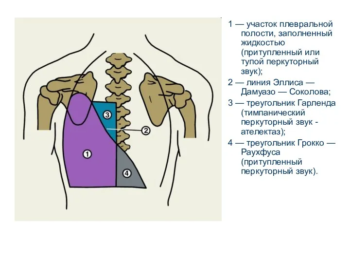 1 — участок плевральной полости, заполненный жидкостью (притупленный или тупой