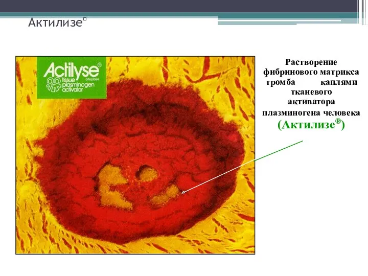 Актилизе Растворение фибринового матрикса тромба каплями тканевого активатора плазминогена человека (Актилизе®)