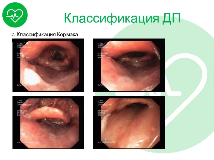 Классификация ДП 2. Классификация Кормака-Лехана