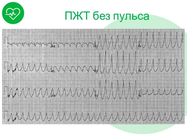 ПЖТ без пульса