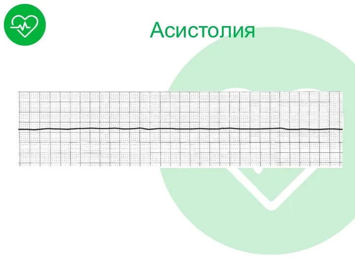 Асистолия