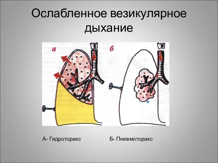 Ослабленное везикулярное дыхание А- Гидроторакс Б- Пневмоторакс