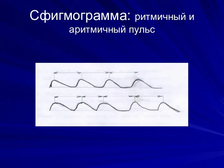 Сфигмограмма: ритмичный и аритмичный пульс