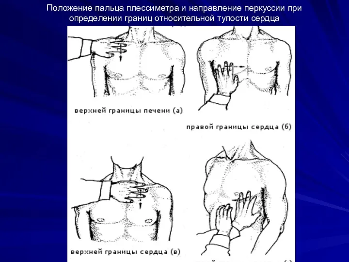 Положение пальца плессиметра и направление перкуссии при определении границ относительной тупости сердца