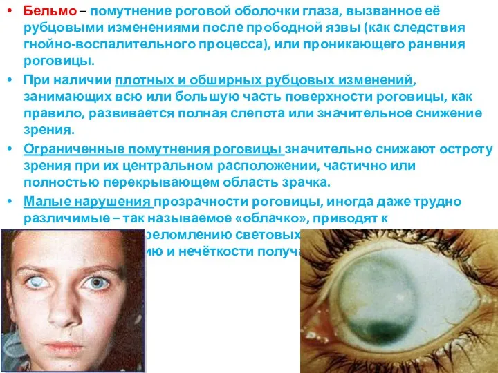 Бельмо – помутнение роговой оболочки глаза, вызванное её рубцовыми изменениями после прободной язвы