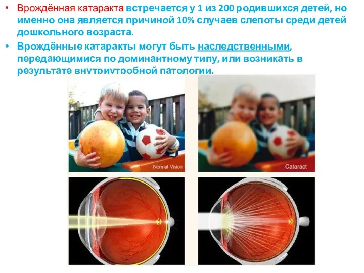 Врождённая катаракта встречается у 1 из 200 родившихся детей, но именно она является