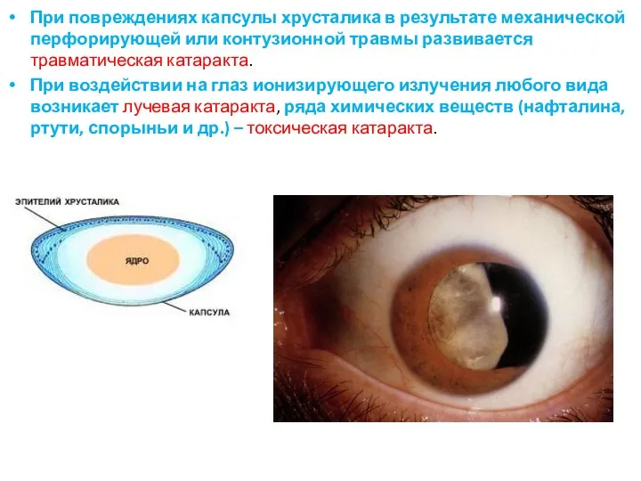 При повреждениях капсулы хрусталика в результате механической перфорирующей или контузионной травмы развивается травматическая