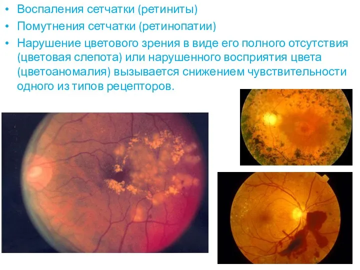 Воспаления сетчатки (ретиниты) Помутнения сетчатки (ретинопатии) Нарушение цветового зрения в виде его полного