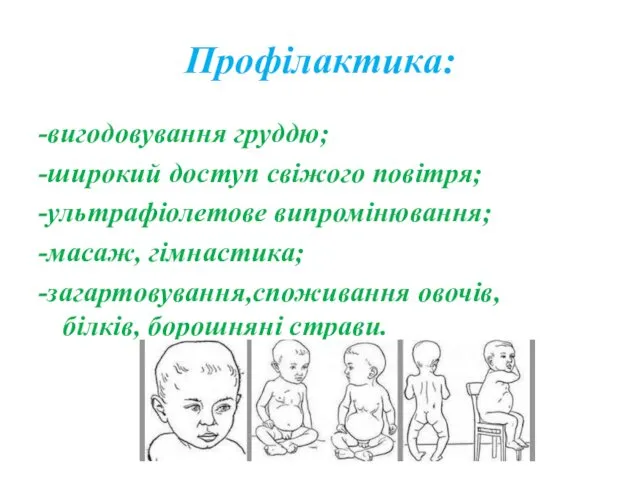 Профілактика: -вигодовування груддю; -широкий доступ свіжого повітря; -ультрафіолетове випромінювання; -масаж, гімнастика; -загартовування,споживання овочів, білків, борошняні страви.