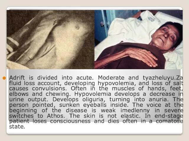 Adrift is divided into acute. Moderate and tyazheluyu.Za fluid loss